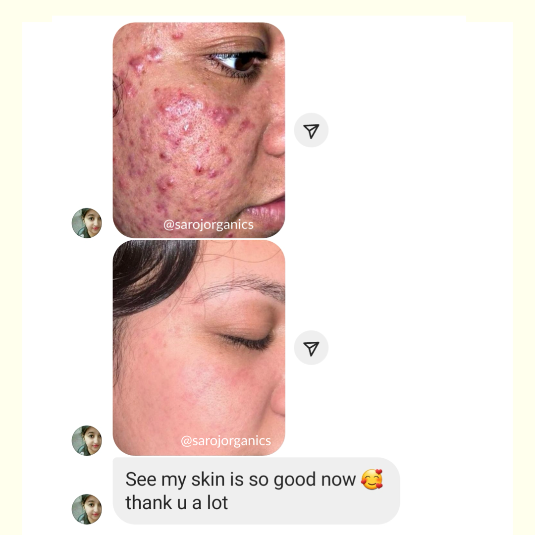All Clear Kit for acne, pimples, acne marks, Blackheads, open pores, anti acne and blemishes - for men and women