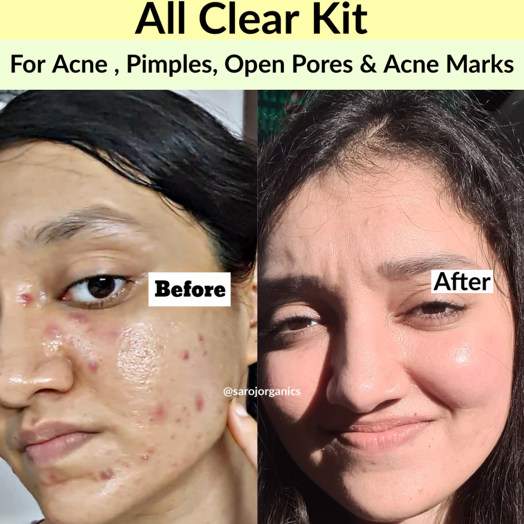 All Clear Kit for acne, pimples, acne marks, Blackheads, open pores, anti acne and blemishes - for men and women