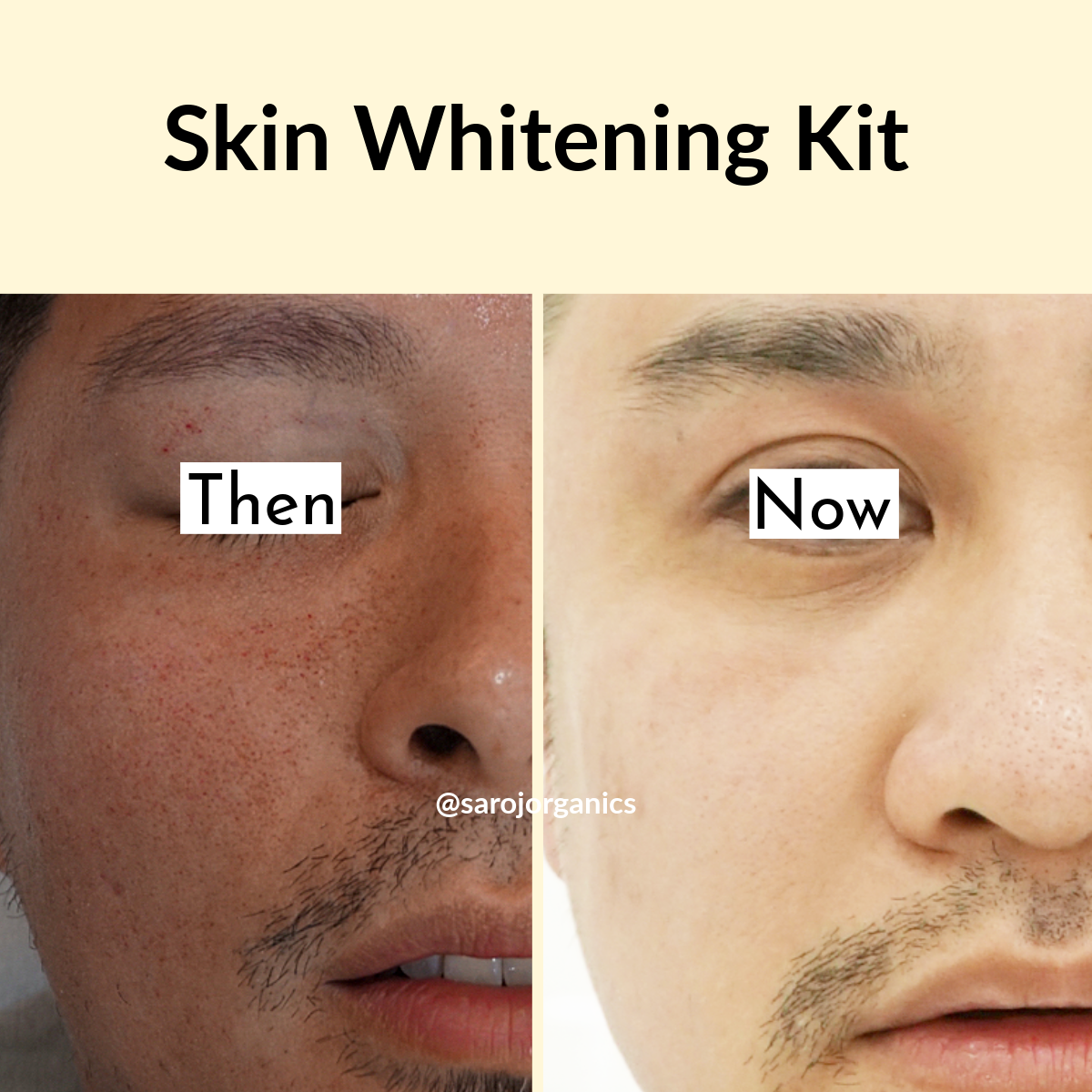 Skin Whitening KIT for skin glow, whitening, pigmentation, tanning and uneven skintone for men and women