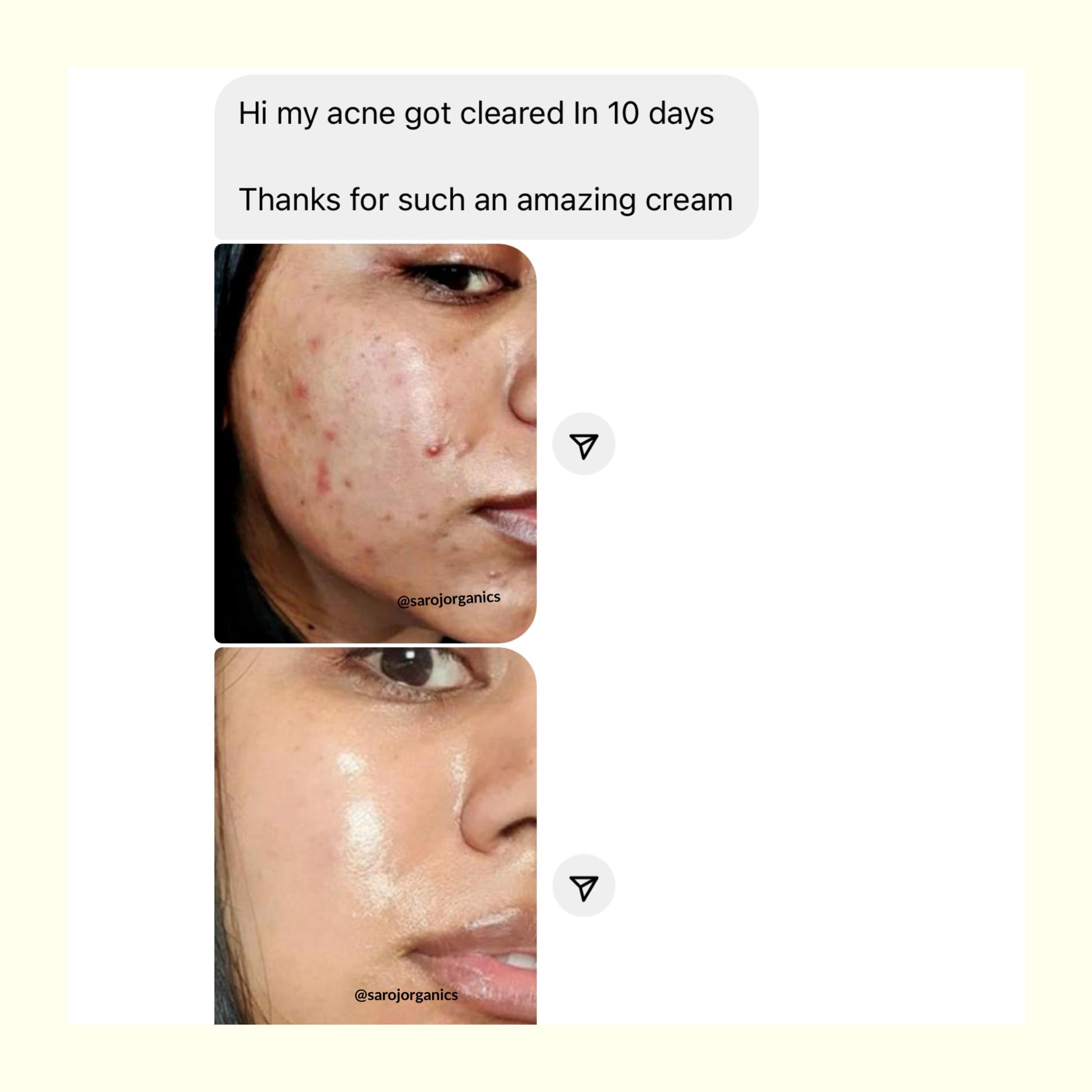 All clear cream with Face wash for acne, pimples, acne marks, open pores, anti acne and blemishes - for men and women
