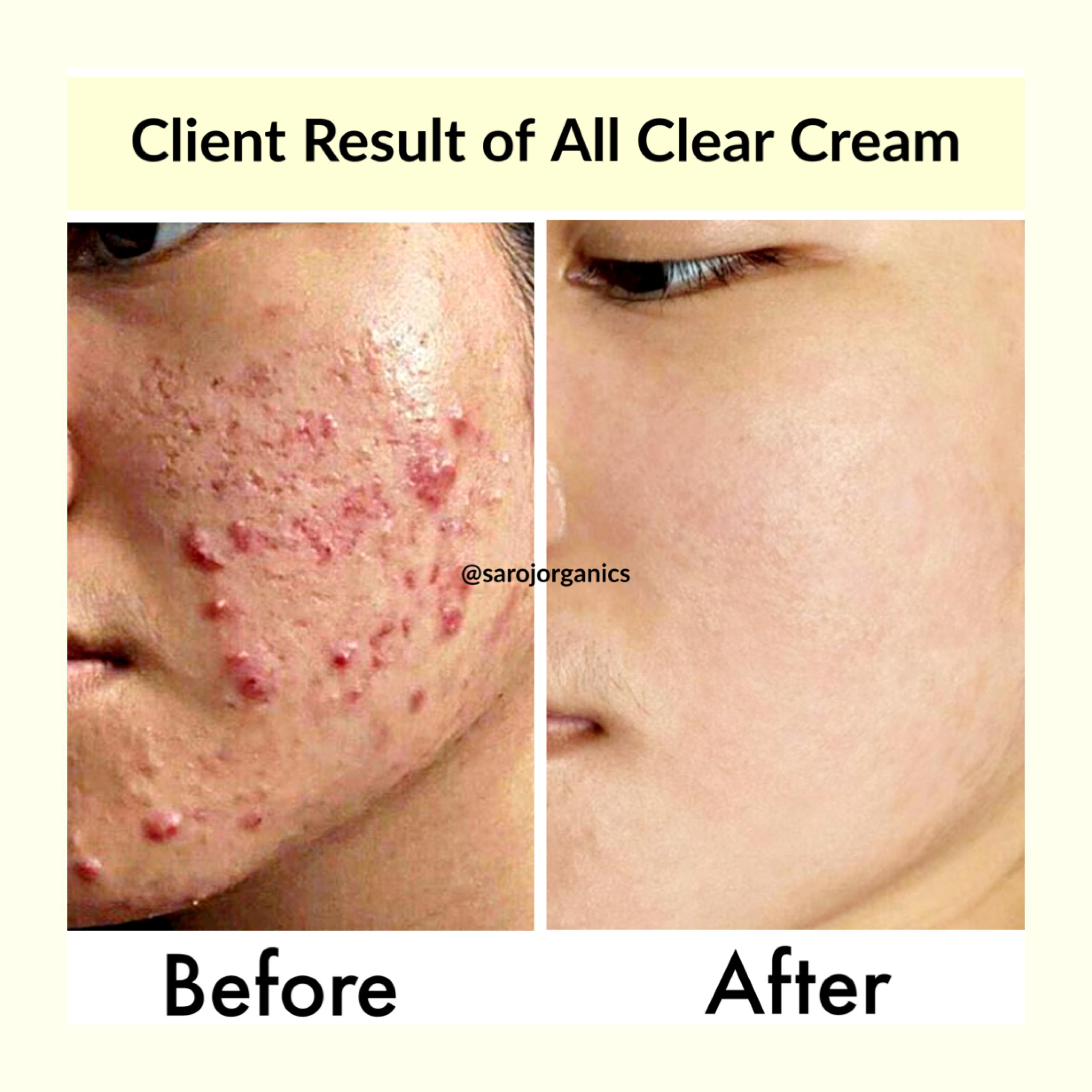 All Clear Cream, 50gm, for acne, pimples, acne marks, open pores, anti acne and blemishes - for men and women