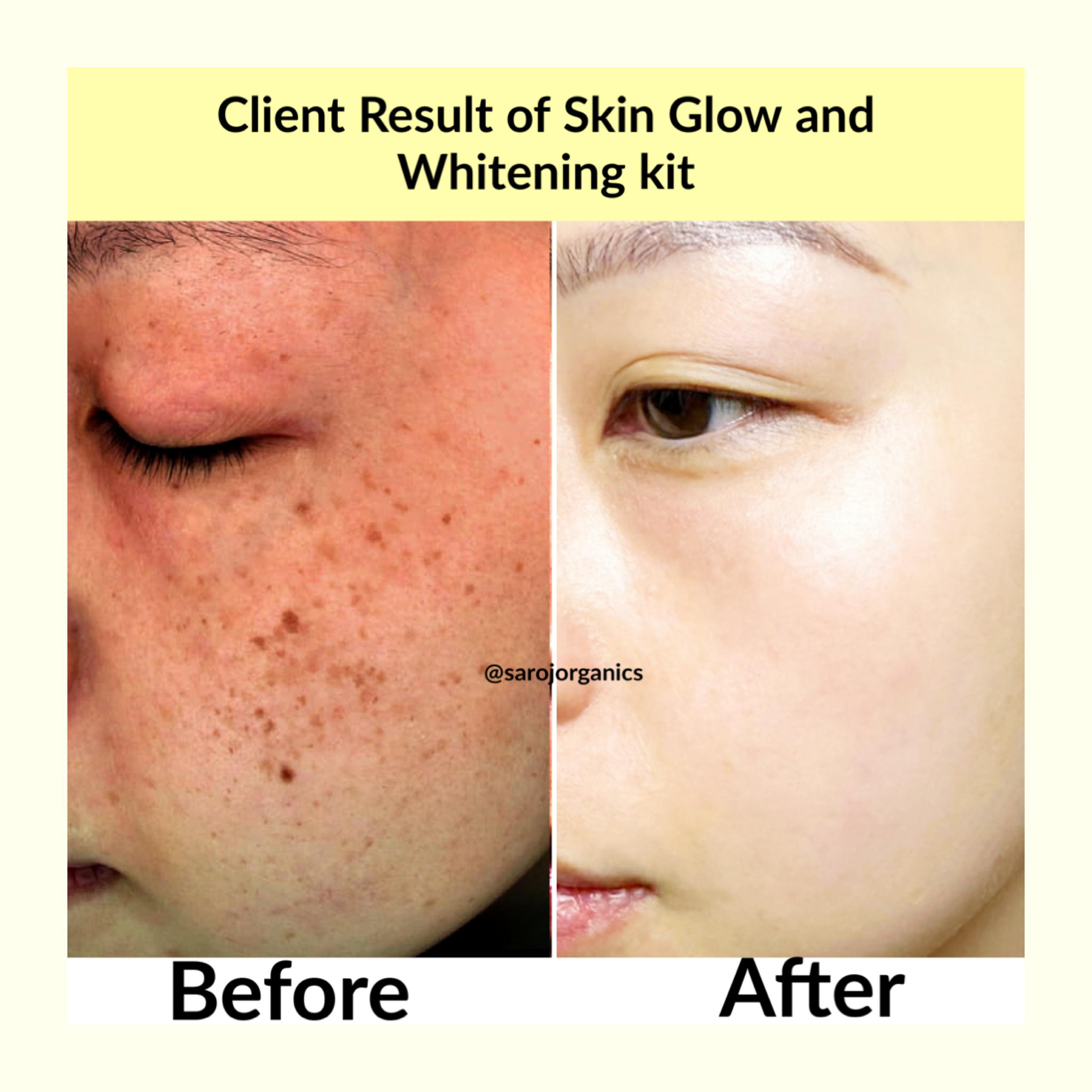 Skin Whitening KIT for skin glow, whitening, pigmentation, tanning and uneven skintone for men and women