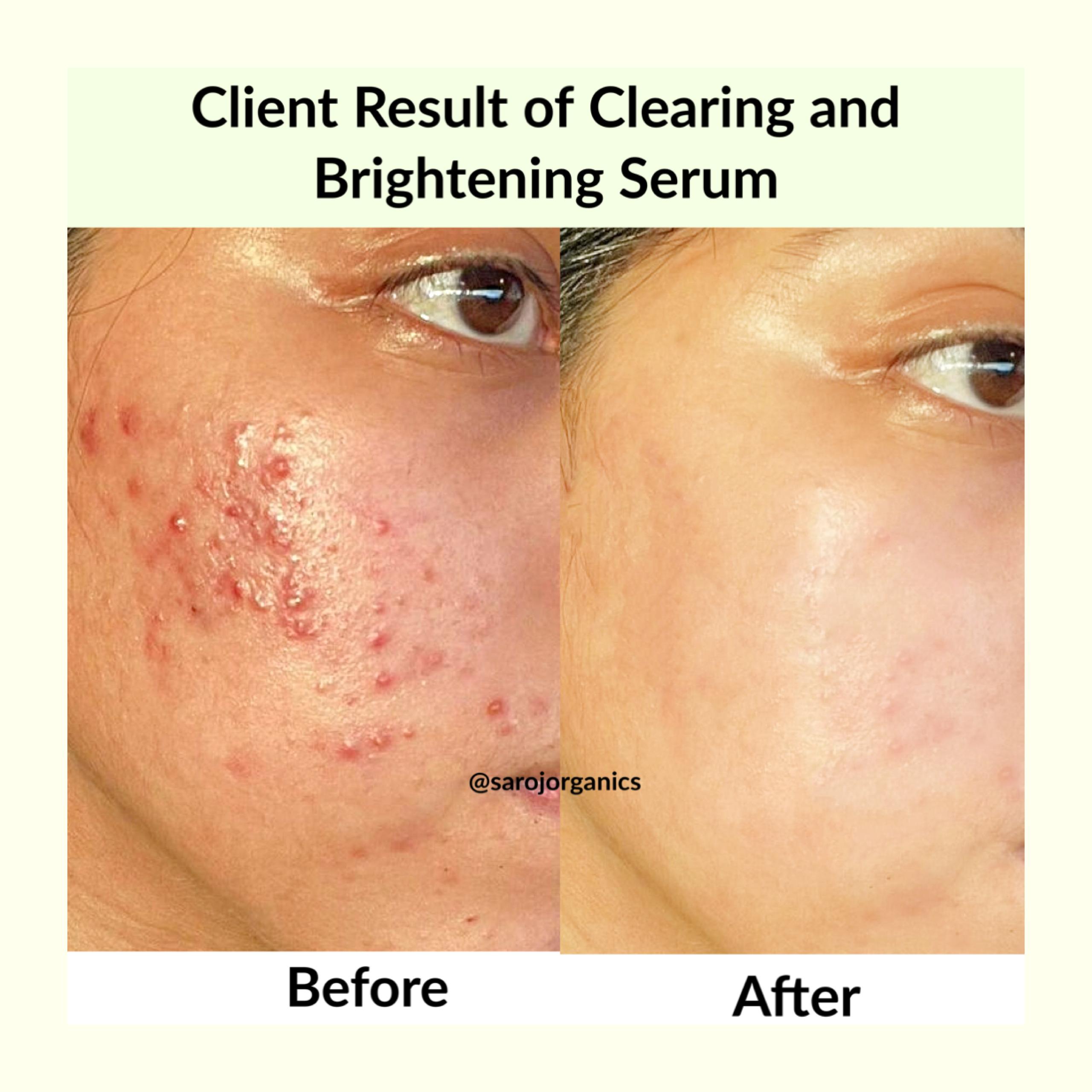 Clearing and Brightening Serum 30 ml for tanning, skin whitening,acne, blemishes, and acne marks, skin glow