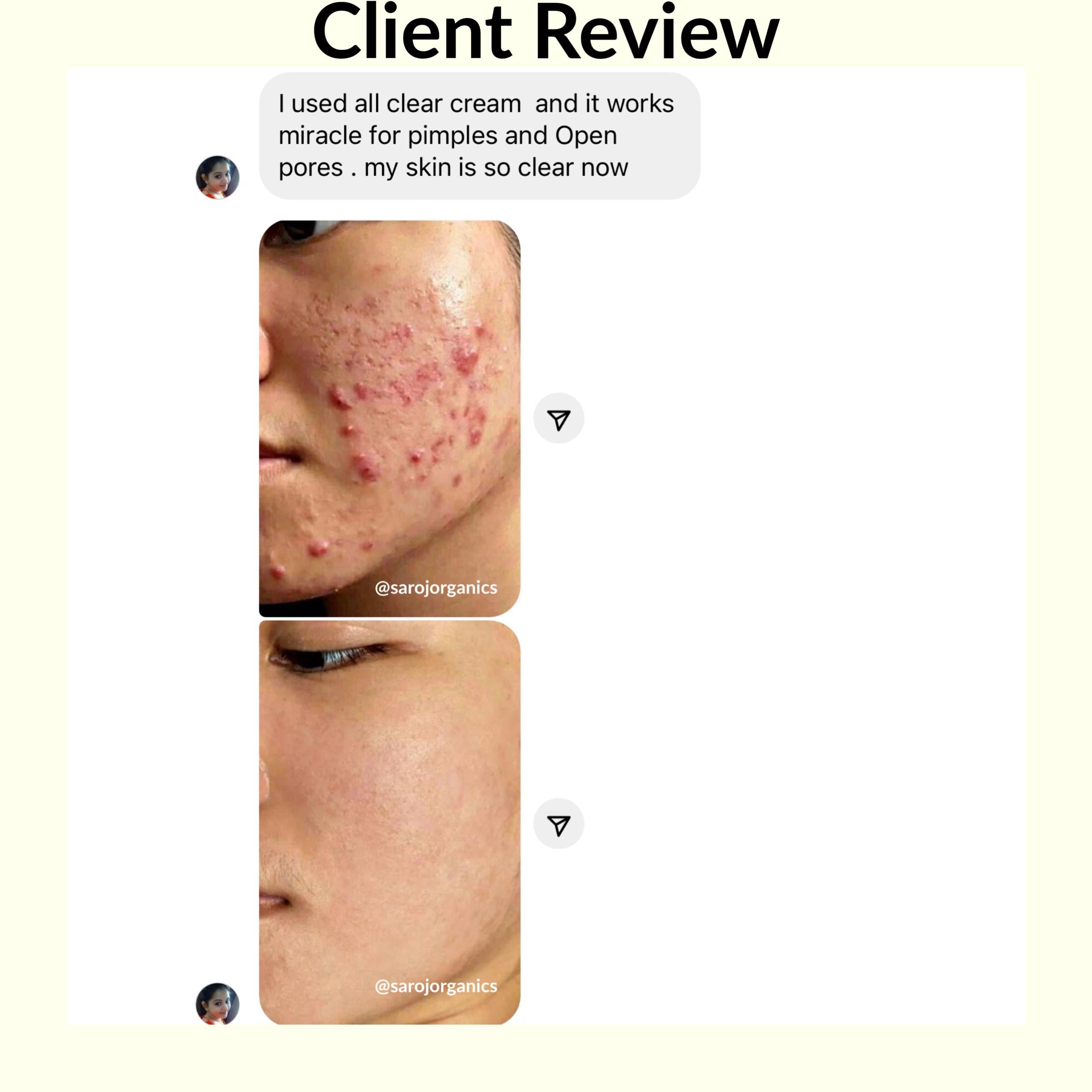 All Clear Cream, 50gm, for acne, pimples, acne marks, open pores, anti acne and blemishes - for men and women
