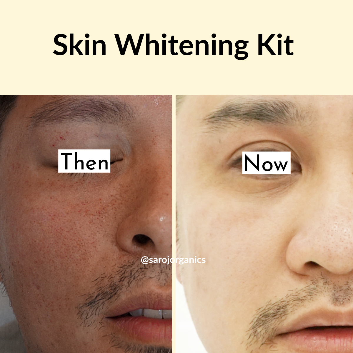 Skin Whitening KIT